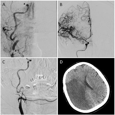 Predictors of Poor Outcome Despite Successful Mechanical Thrombectomy of Anterior Circulation Large Vessel Occlusions Within 6 h of Symptom Onset